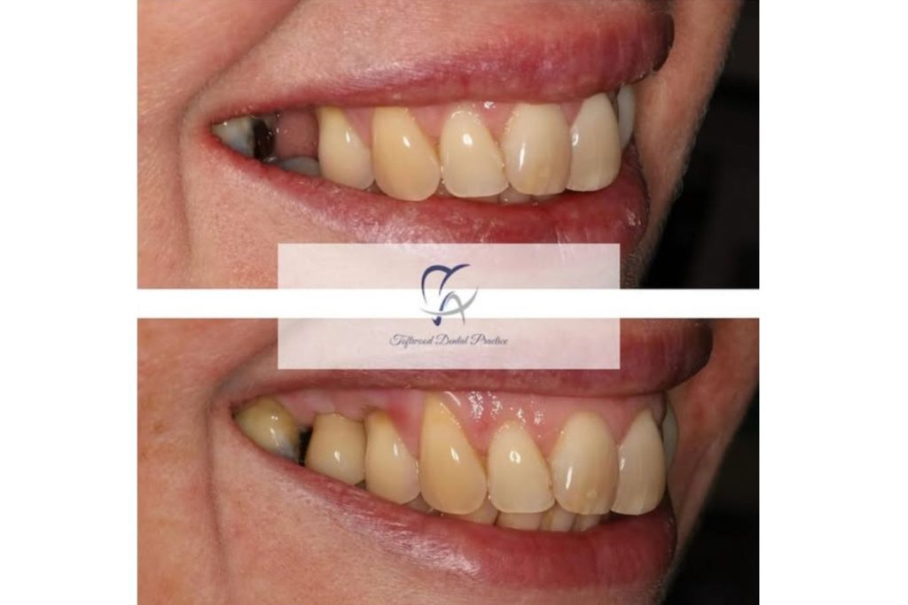 Before and After - dental implant, smile close up from the side.