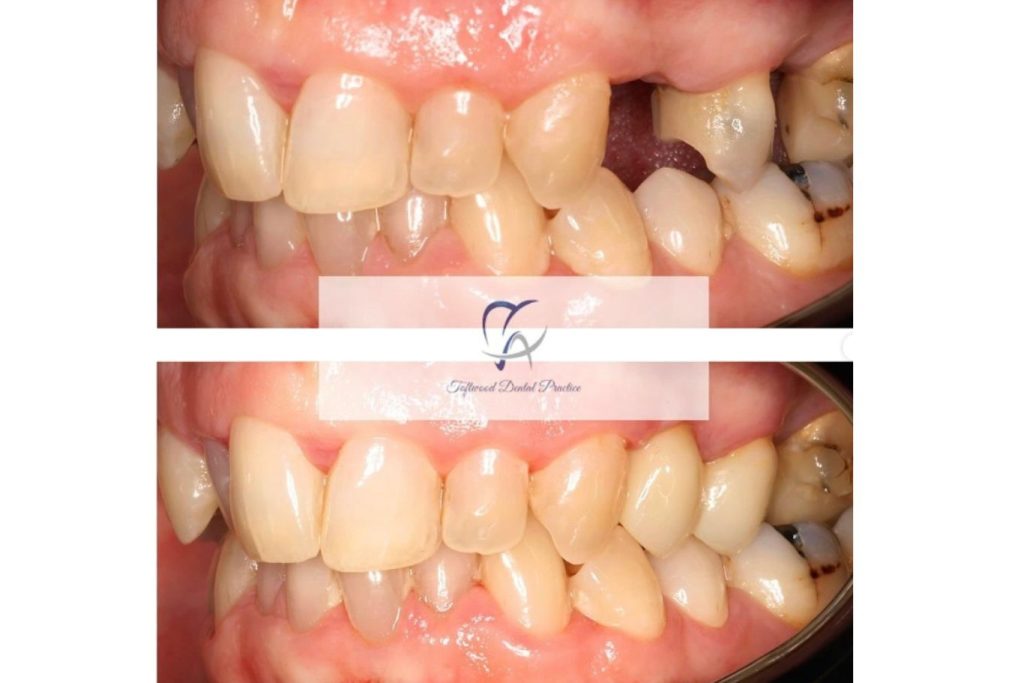 Before and after dental implant, mouth close up from the side